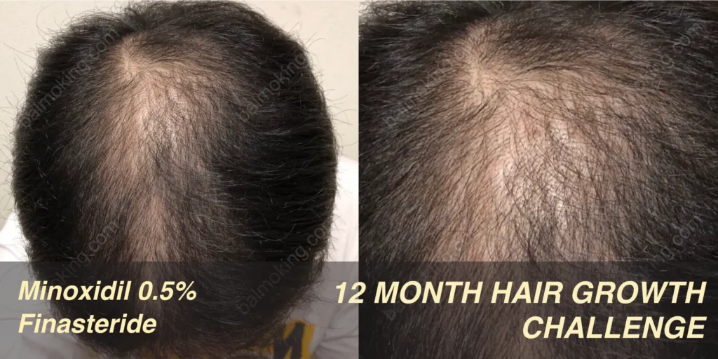 minoxidil finasteride hairgrowth challenge 정수리 탈모