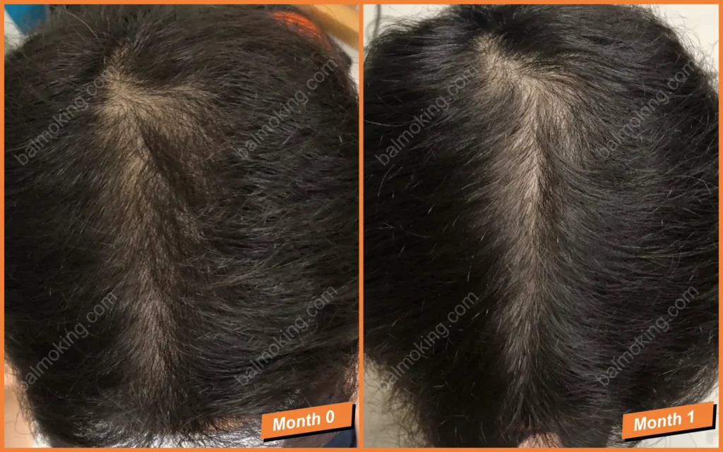 정수리 탈모-lllt-care-0-1month