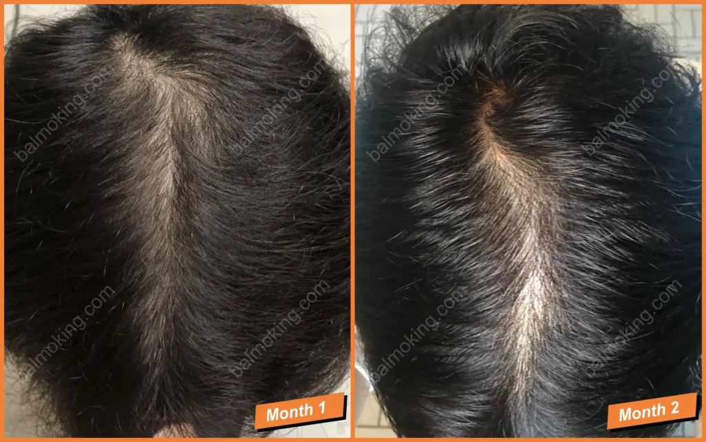 정수리 탈모-lllt-care-1-2month