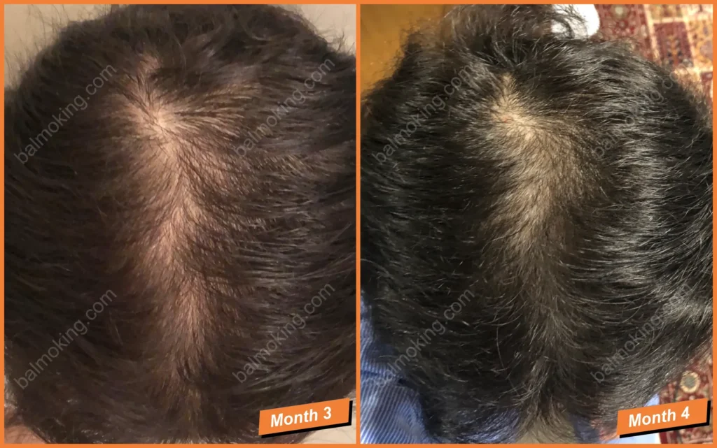 정수리 탈모-lllt-care-3-4month