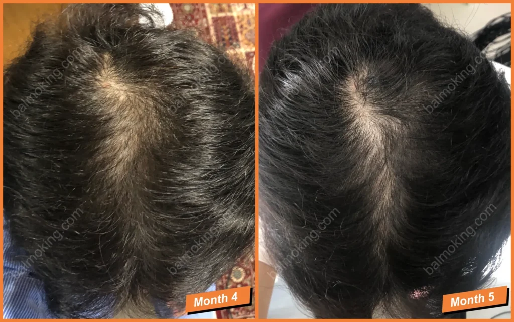 정수리 탈모-lllt-care-4-5month