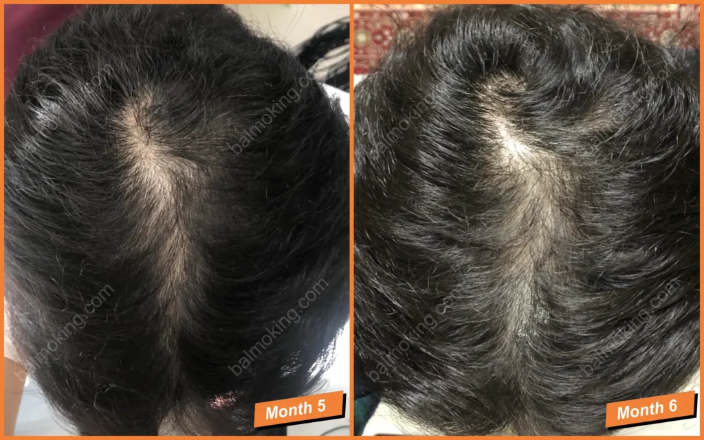 정수리 탈모-lllt-care-5-6month