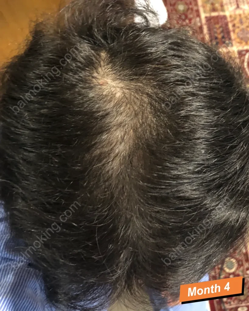 lllt-care-4month
