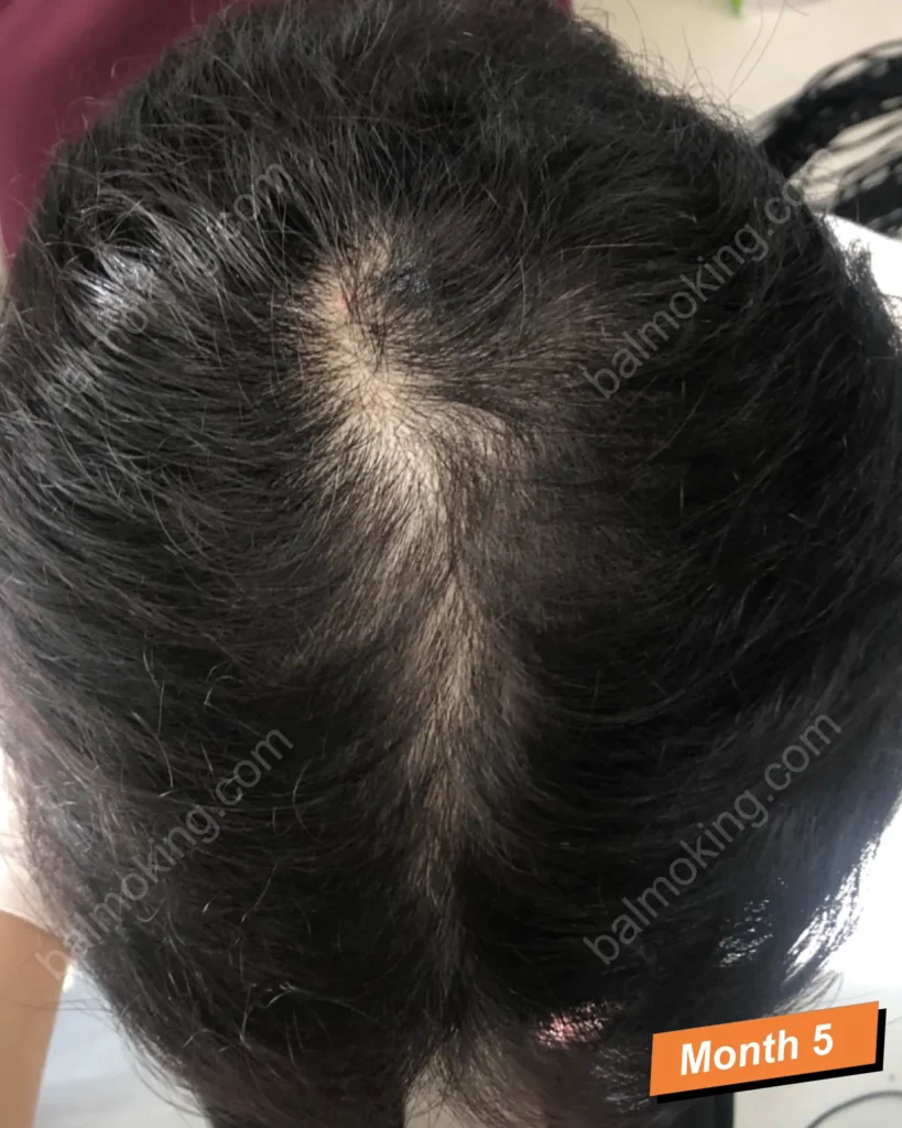lllt-care-5month