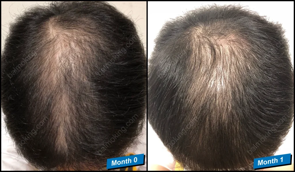 Minoxidil & Finasteride Shedding Phase 쉐딩 현상