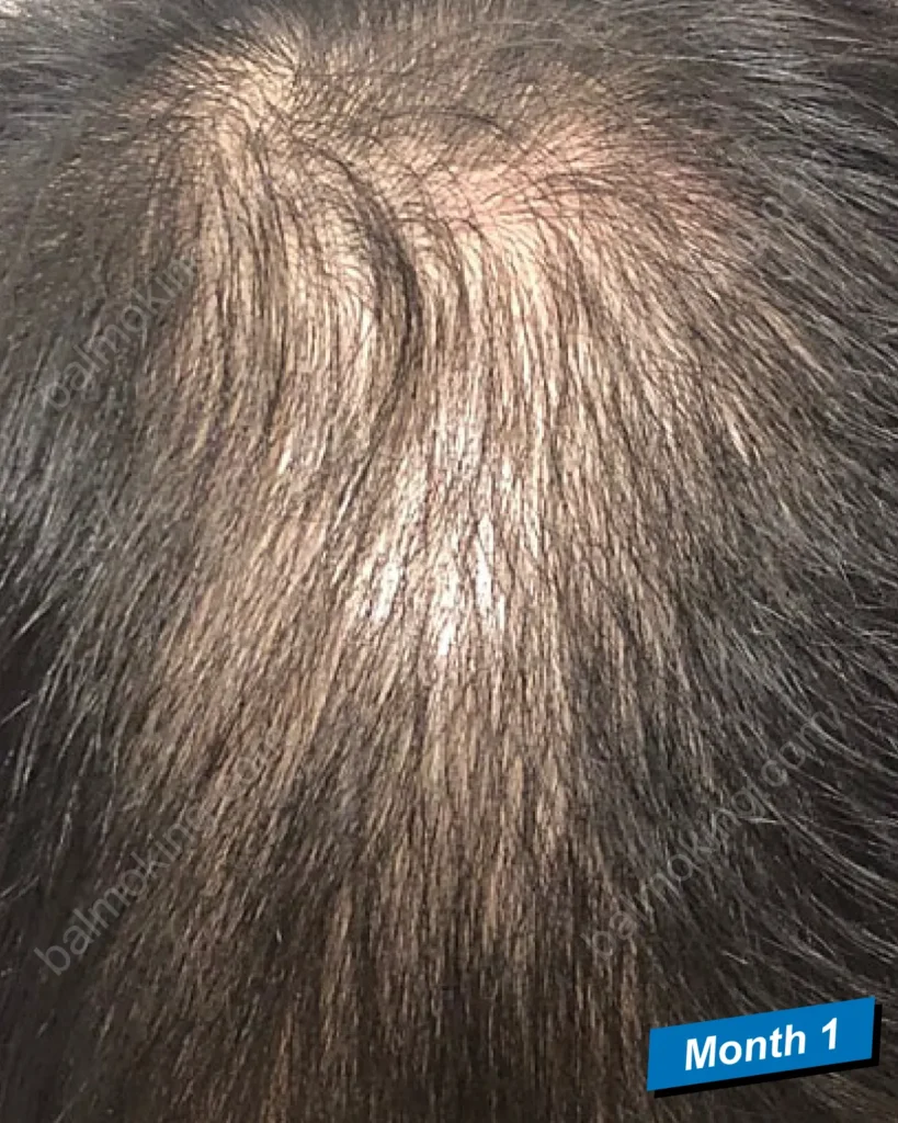 Minoxidil & Finasteride Shedding Phase 쉐딩 현상