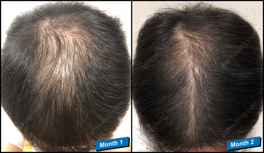 minoxidil-finasteride-정수리 탈모