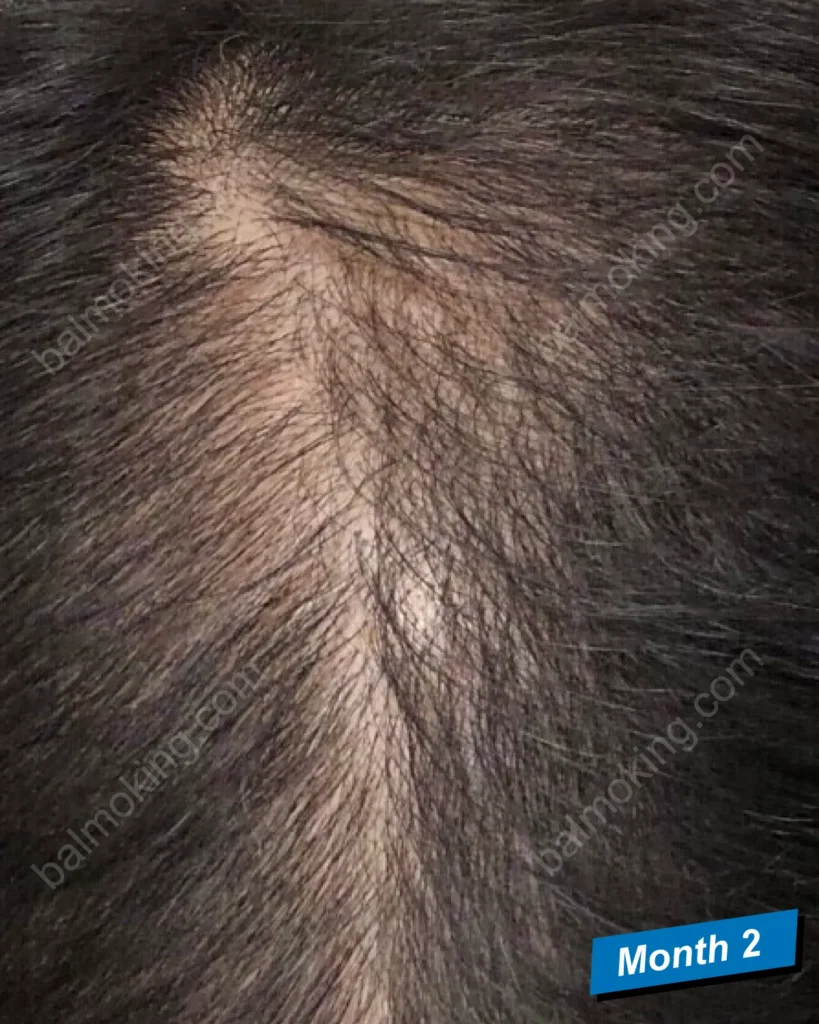minoxidil-finasteride-2 month