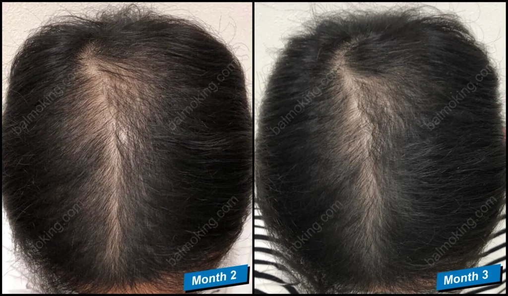 minoxidil-finasteride-정수리 탈모