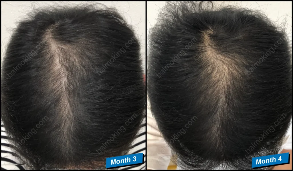 minoxidil-finasteride-정수리 탈모
