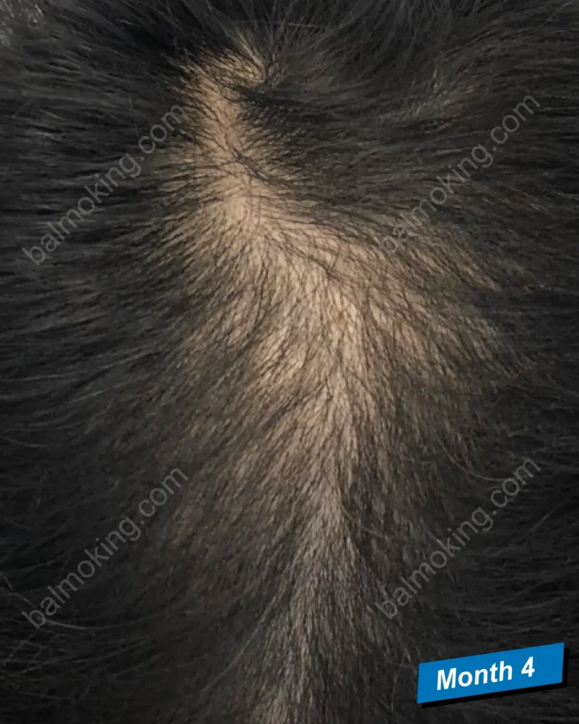 minoxidil-finasteride-month-4