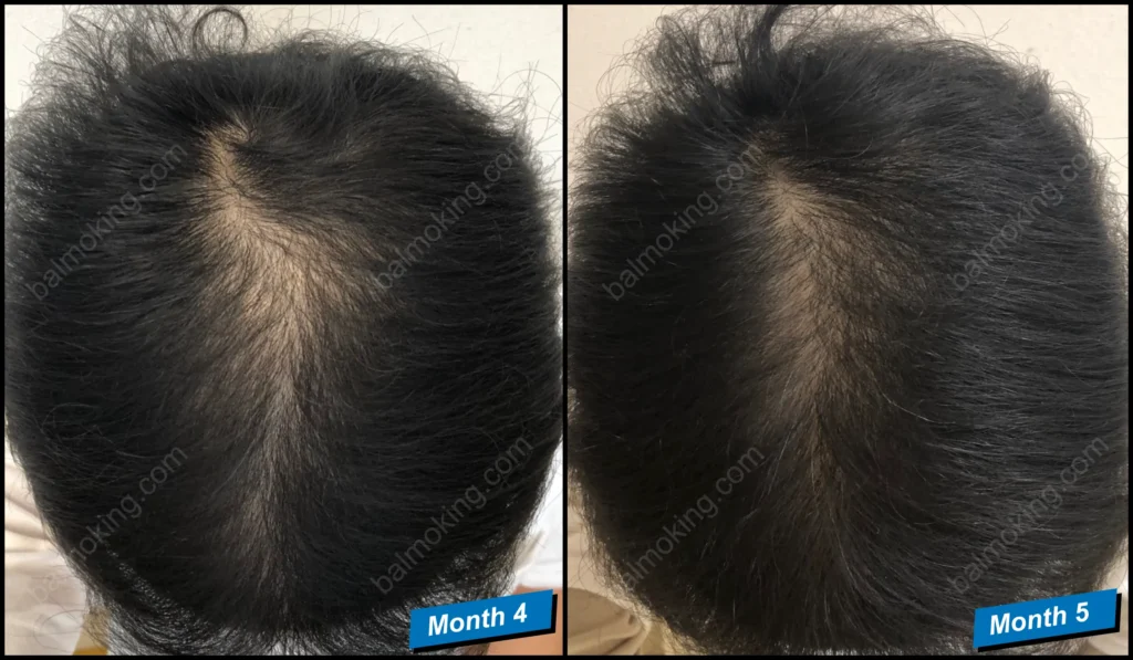 minoxidil-finasteride-정수리 탈모