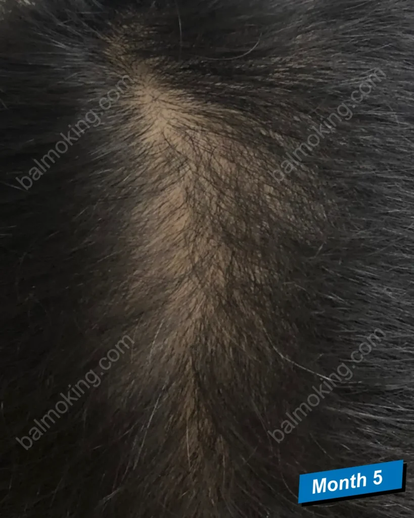 minoxidil-finasteride-month-5