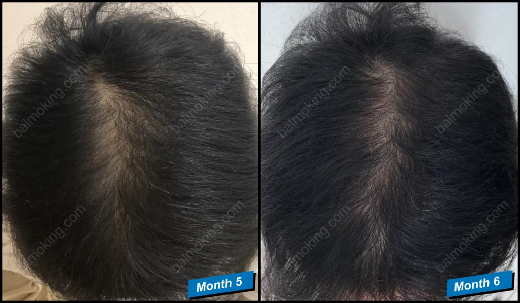 minoxidil-finasteride-정수리 탈모-5-6month-가르마