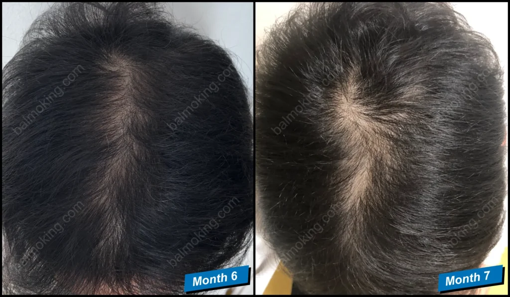minoxidil-finasteride-정수리 탈모-6-7month
