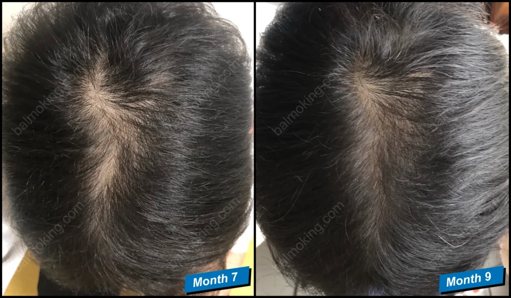 minoxidil-finasteride-정수리 탈모