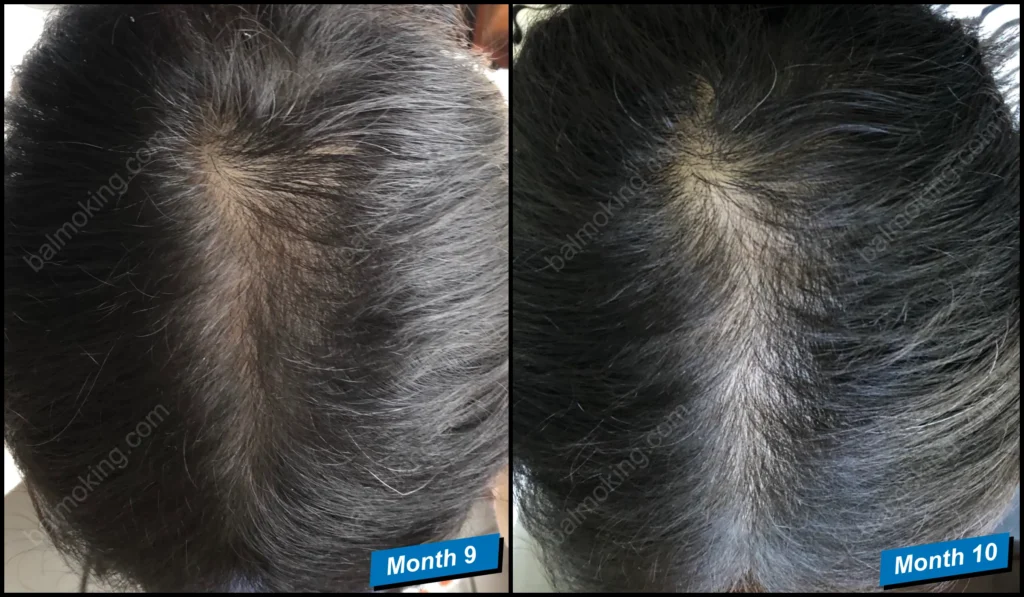 minoxidil-finasteride-정수리 탈모-9-10month-효과가 더 좋아지지 않는 이유