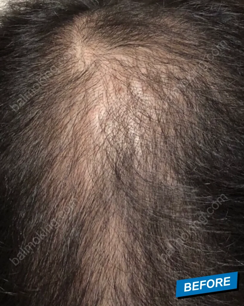 Minoxidil & Finasteride Shedding Phase 쉐딩 현상